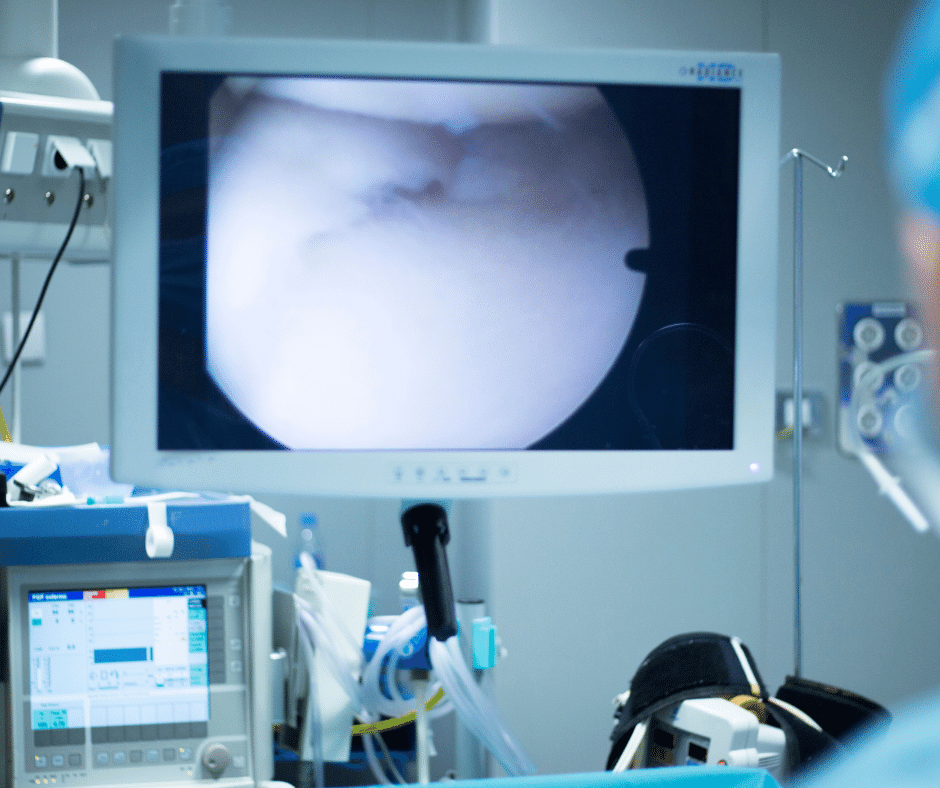 Tiny cameras are inserted into the body in arthroscopic surgery so surgeons can see exactly what is wrong with the shoulder and correct it. loyolamedicine.org/provider/nicko… 

#arthroscopy #arthroscopicsurgery #surgeon #doctor #meniscus #shouldersurgery #sportsmed #arthroscopysurgery