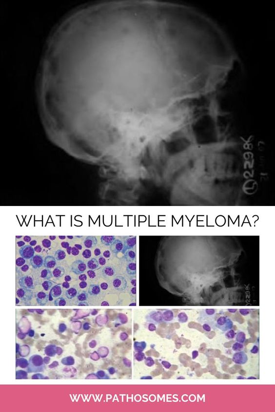 pathosomes's tweet photo. What is Multiple Myeloma?

#cancer #meded #research #science #health #healthcare #pathosomes #twitterpath #MedStudentTwitter #medtwitter #PathMatch2023 #FOAMed #hemepath #Match2023 #path2path https://t.co/X6Pr31JYhN