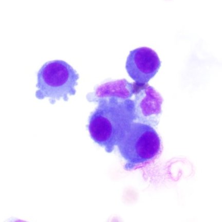 VandaTorousMD's tweet photo. For #FluidsFriday: CSF with metastatic lung adenocarcinoma
Contrast size and appearance of the lesional cells to background monocytes. Additional feature of cytoplasmic blebbing seen here #CytoPath #PathTwitter https://t.co/1z4fXa0n2g