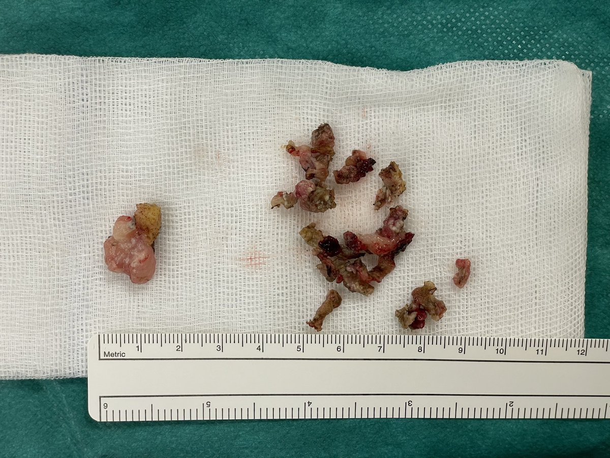DavDandrea's tweet photo. Which #TURB specimen do you think a pathologist would like have?
#eBLOC https://t.co/aKEI1euF2t