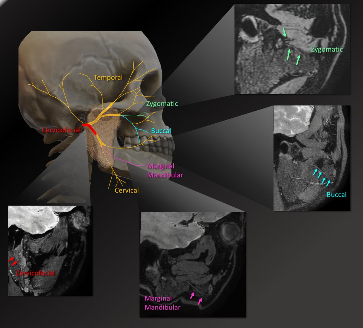 Lea Alhilali, MD tweet media