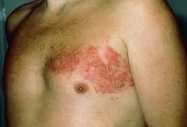 Sports_Doctor2's tweet photo. It's IMPORTANT to screen for HIV if you notice any of these symptoms;

- Oral thrush (Candidiasis) -Pic1
- Unexplained weight loss
- Swellings in your neck, groin, and armpit
- Diarrhea for more than 1 week
- Herpes Zoster (Shingles)- Pic2

Retweet for others. https://t.co/tcGjxnTb3v