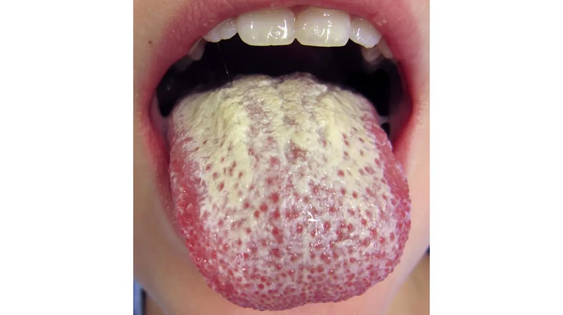 Sports_Doctor2's tweet photo. It's IMPORTANT to screen for HIV if you notice any of these symptoms;

- Oral thrush (Candidiasis) -Pic1
- Unexplained weight loss
- Swellings in your neck, groin, and armpit
- Diarrhea for more than 1 week
- Herpes Zoster (Shingles)- Pic2

Retweet for others. https://t.co/tcGjxnTb3v