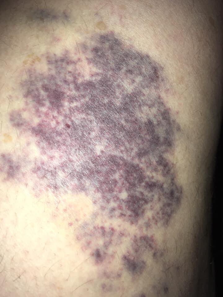mysticsol8's tweet photo. @TheEmilyDBaker Real bruise from me just moving furniture https://t.co/jL32Bekh8U