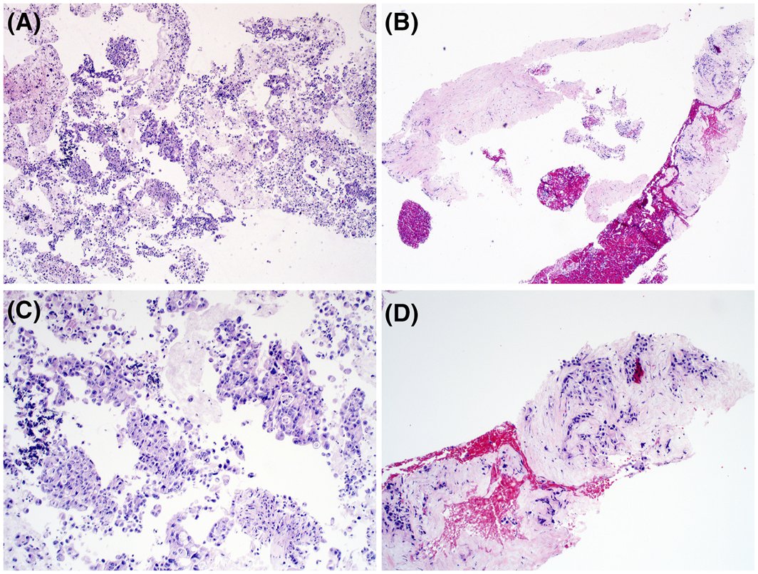 CancerCytopath's tweet photo. Just published! Comprehensive molecular profiling of pancreatic ductal adenocarcinoma in FNA, biopsy, and resection specimens https://t.co/MrWUYqN1ot @gcai1978 #CytoPath #FNAPath #endpath https://t.co/GQmseohyEl