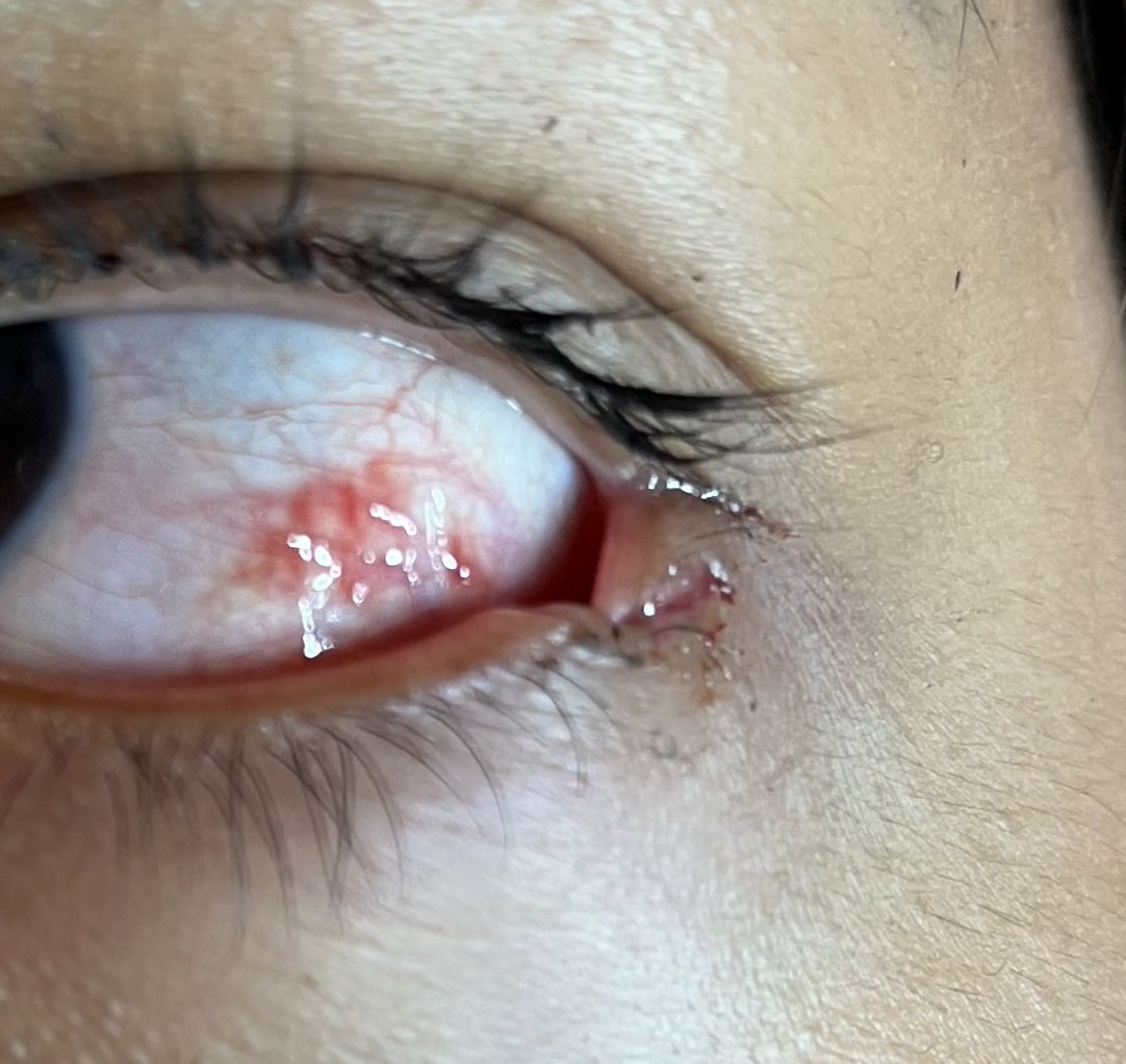 rachloud's tweet photo. Kay.. 
I don’t usually do this, 
But seriously, If I have to recommend you a beauty/health product, it would be 
￼ “Hydrolyzed Bovine Collagen Peptides” 
The Dog bite scars on my friggin FACE (left eye and lower jaw) are BARELY VISIBLE anymore!

They were kinda bad 😗 https://t.co/yEkmLjEQ1L