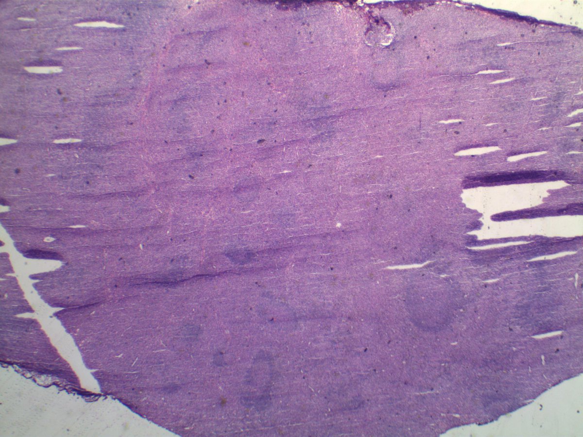 EKoubaMD's tweet photo. Sentinel LN frozen w/ of lobular breast carcinoma. Intraparenchymous pattern of metastasis; frozens and corresponding permanent #frozenpath #breastpath #pathology https://t.co/5tZdIUlL2i