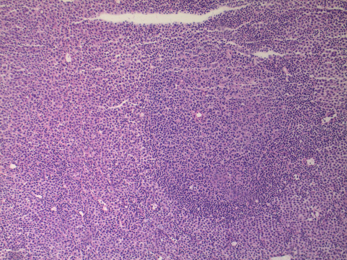 EKoubaMD's tweet photo. Sentinel LN frozen w/ of lobular breast carcinoma. Intraparenchymous pattern of metastasis; frozens and corresponding permanent #frozenpath #breastpath #pathology https://t.co/5tZdIUlL2i