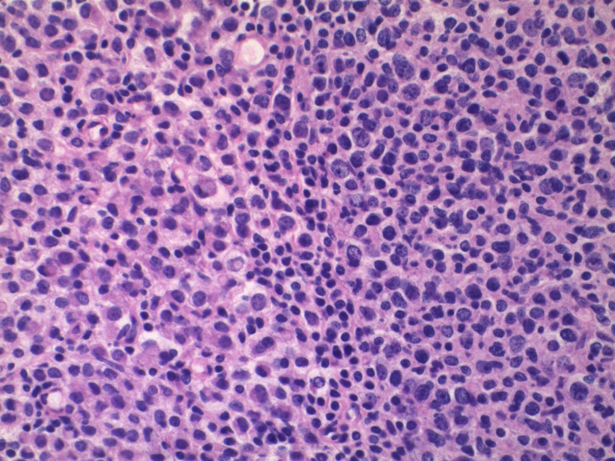 EKoubaMD's tweet photo. Sentinel LN frozen w/ of lobular breast carcinoma. Intraparenchymous pattern of metastasis; frozens and corresponding permanent #frozenpath #breastpath #pathology https://t.co/5tZdIUlL2i