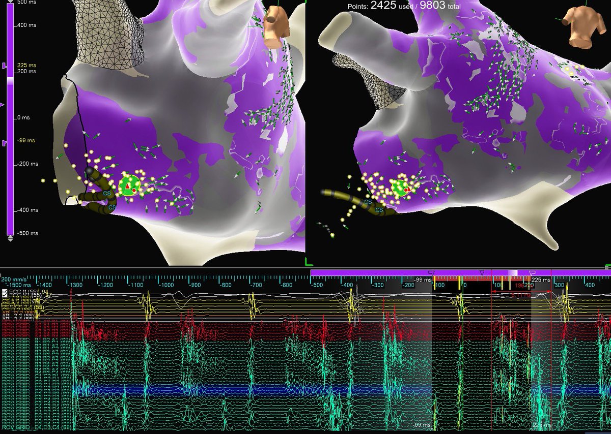 Margaret Boyette Kleiber (@buckboykleib) on Twitter photo Beautiful map by <a href="/NilssonEP/">Kent Nilsson, MD</a> led us to these juicy signals accounting for 57% of this atypical flutter’s cycle length. #OmnipolarTechnology strikes again! #SeeTheEP #OnlyWithOT #Xmarksthespot #EnsiteX #EPeeps <a href="/AbbottCardio/">Abbott Cardiovascular</a> Beautiful map by <a href="/NilssonEP/">Kent Nilsson, MD</a> led us to these juicy signals accounting for 57% of this atypical flutter’s cycle length. #OmnipolarTechnology strikes again! #SeeTheEP #OnlyWithOT #Xmarksthespot #EnsiteX #EPeeps <a href="/AbbottCardio/">Abbott Cardiovascular</a>