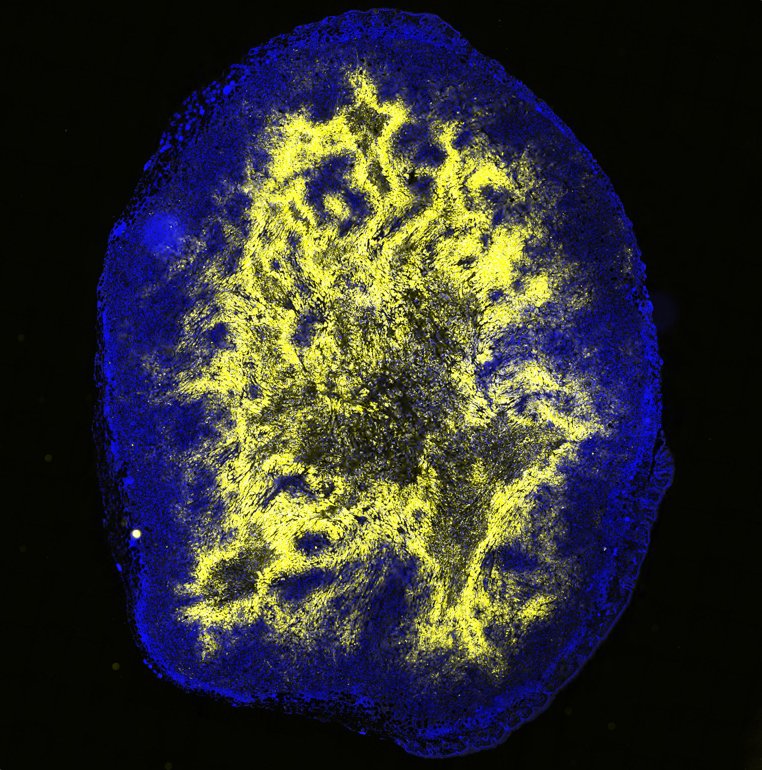 HMS_NIF's tweet photo. Here's a cross-section of a pancreatic tumor xenograft stained for nuclei (DAPI), target we are working on that is highly present in a hypoxic core of the tumor (RED), and a GFP-tagged inducible cassette.  
VS120 Slidescanner, processed in Omero.
By: @nina_k0zlova
PI: Muranen Lab https://t.co/iH61FWB04N