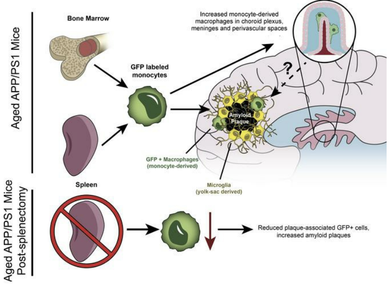 Our publication in JCI showing how monocytes assist with degradation of amyloid in Alzheimer’s Disease.

jci.org/articles/view/…

#diwanlab #wustl #JCI