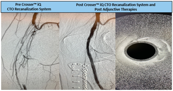 TimHugBD's tweet photo. Patient presented with 15cm CTO from SFA to AT artery. Dr. Cawich crossed using #CrosseriQ catheter and observed a 1 min 21 sec activation time. Great results!#CrossThisFast
For use in peripheral artery CTOs; Not for use in carotid arteries. Safety info: https://t.co/4Hu46prfw9 https://t.co/IojT4pPwx2