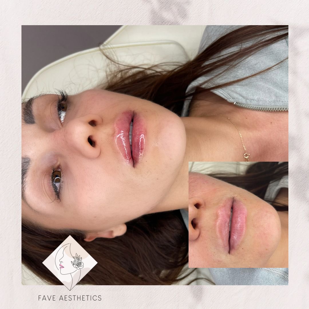 BeauTanningNW's tweet photo. Slightest Lip Touch 💉https://t.co/4oSRyoxIXd https://t.co/9HmStnX51Q