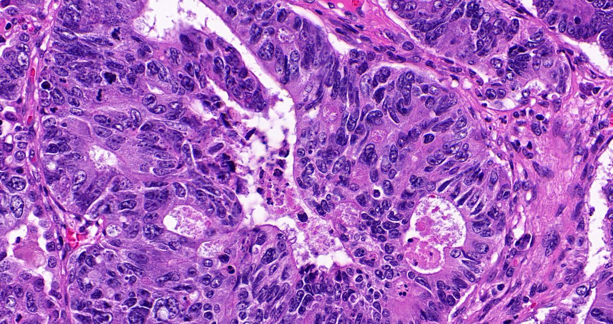 Lung, adult.

#Pulmpath #GIpath #Pathresident #Pathtwitter