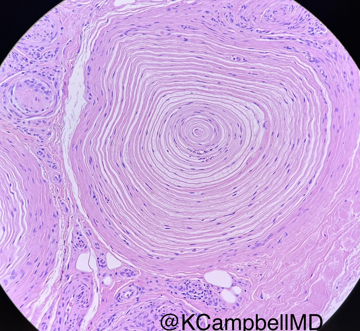 The perfect pair of Pacinians! 🧅😵‍💫😆 

#histology #dermpath