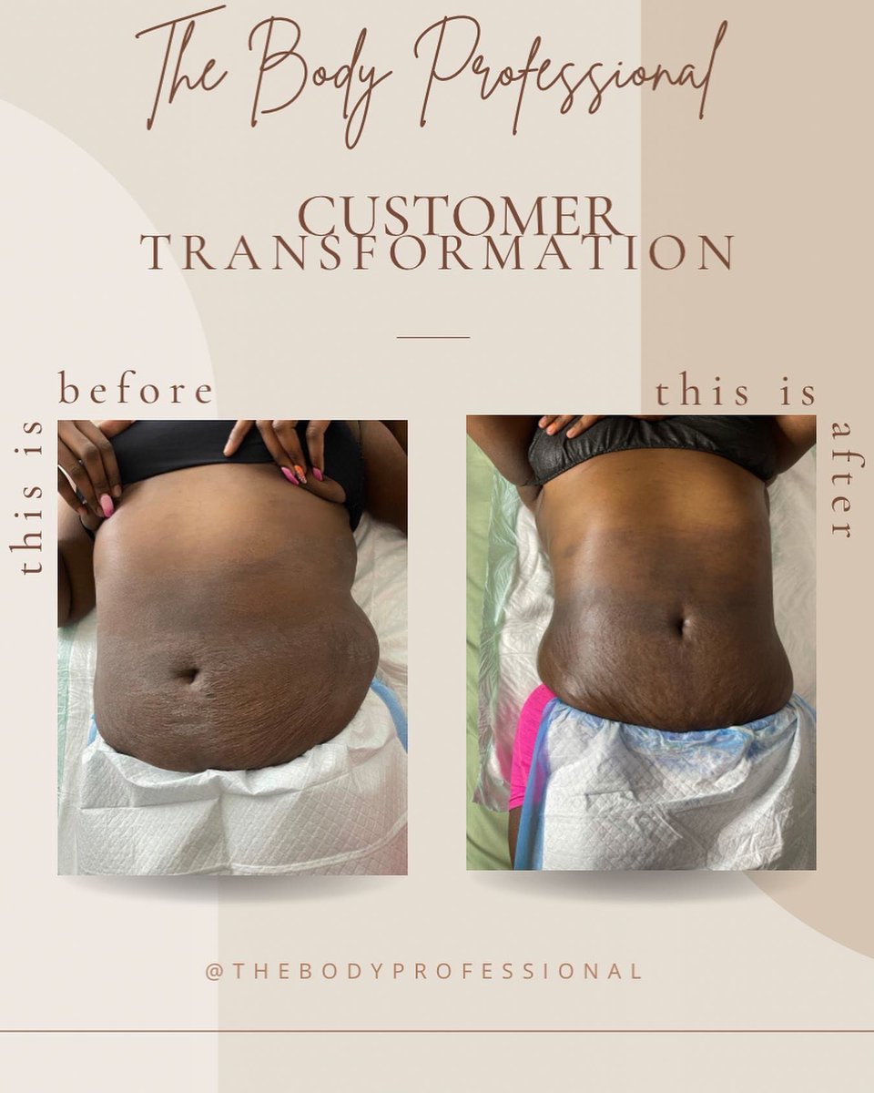 TheBodyPro_'s tweet photo. HEY MAMA'S AND LADIES 👋🏾 . I HAVE A MEGA SALE RUNNING ALL MONTH DEDICATED TO MY MOTHERS 😌❤️. As mommies our bodies go through so many changes! We gain weight and our body stretches and so much more. Being a mother myself I completely understand.#Atlanta #atlantabodycontouring https://t.co/lWBlso0gKr