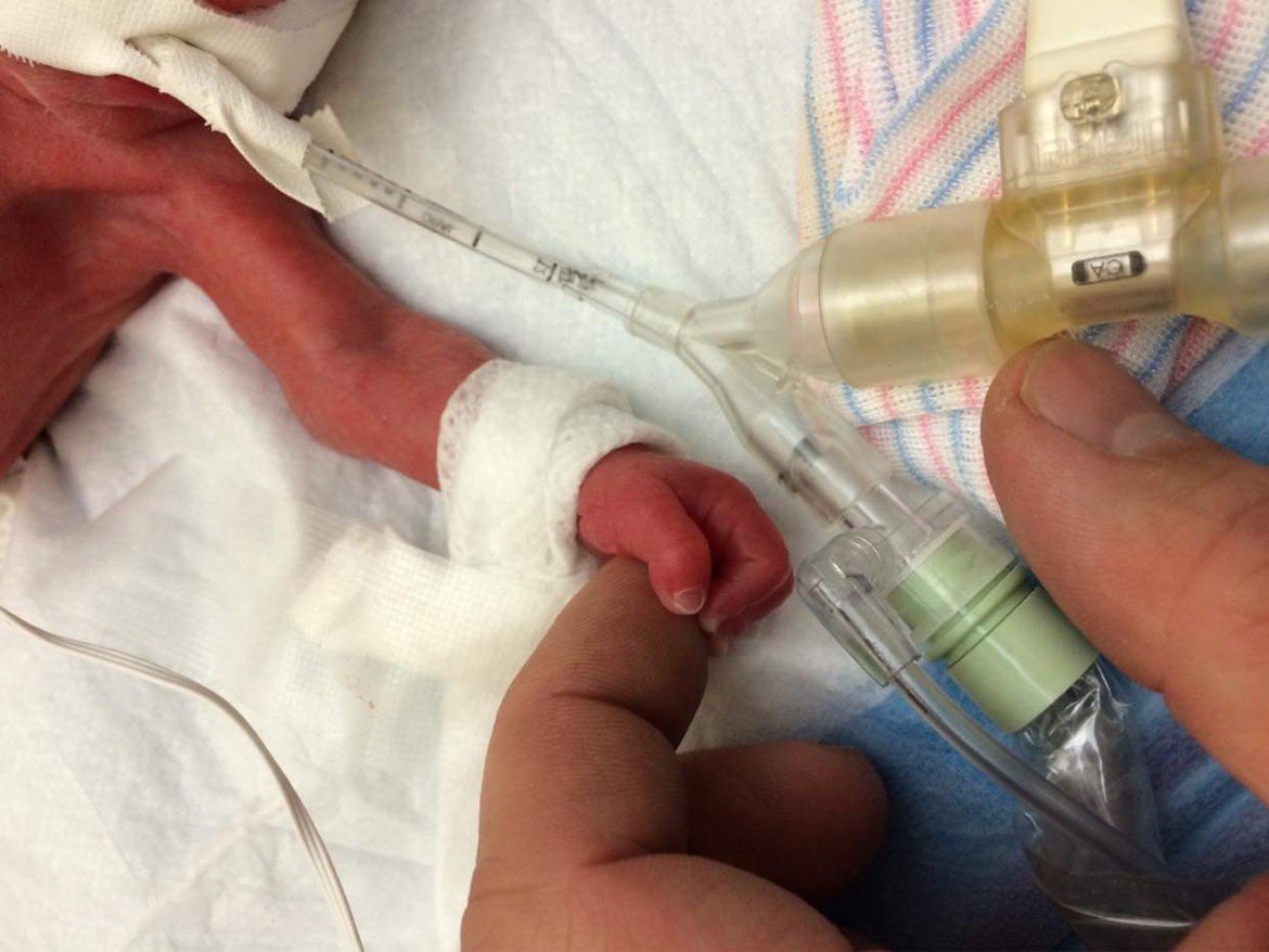 AtlasThundr's tweet photo. @Oldglorycries Just for reference, my friends baby was born at 23 weeks. There she is holding her dads hand seconds after she was born. One week later than being ripped to shreds as this doc describes. Today she’s a happy healthy 7 year old. #NotOneMoreForMoloch https://t.co/0znus5nmgQ