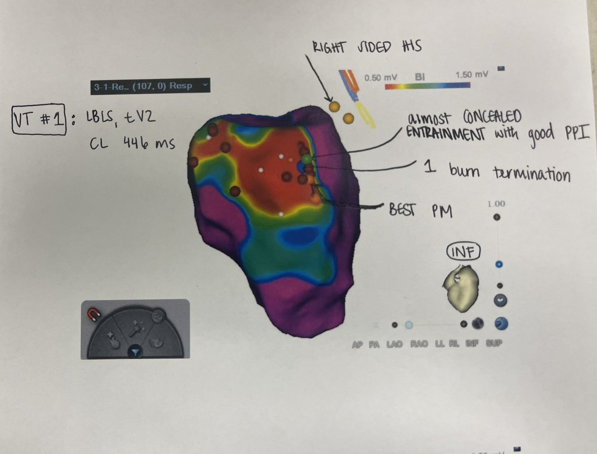 VT storm patient. Near concealed entrainment with good PPI. Single burn and patient was no longer inducible for VT. Does not have to be perfectly concealed to be in the right spot. #EPeeps @BiosenseWebster