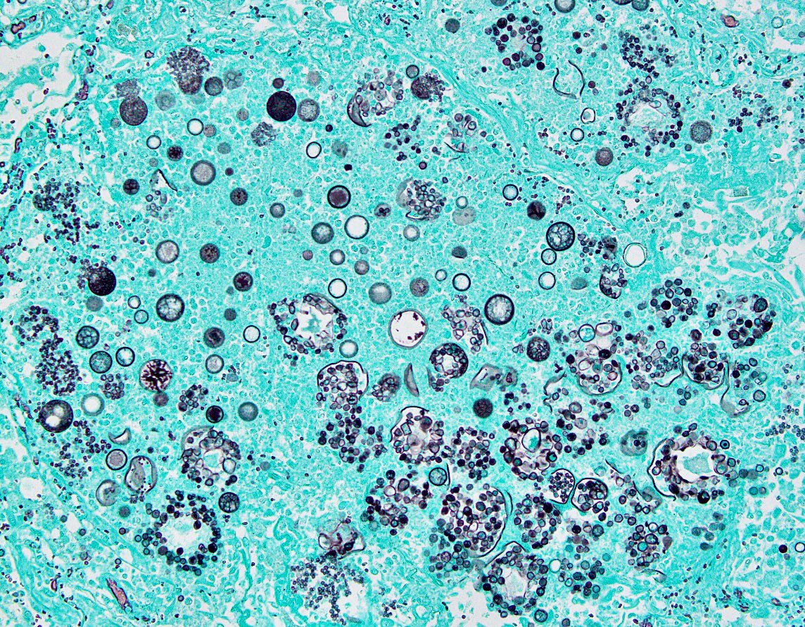 Lung resections shows a mycetoma containing the dimorphic fungus Coccidioides immitis. Endospores are seen erupting from spherules. GMS stain. #PathArt #PathTwitter #MedTwitter #IDTwitter #Fungi