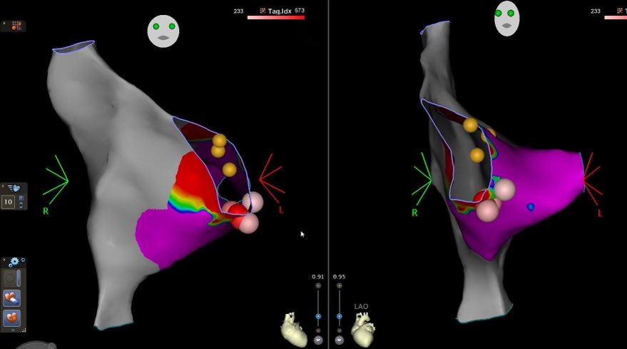 AFPanico (@az_ep_doc) on Twitter photo Nice bread and butter EPS and AVNRT ablation today with <a href="/uazmedphx/">UAZ Medicine - Phoenix</a> fellow <a href="/varuntandonMD/">Varun Tandon</a> forgot how much I enjoy working with fellows.
<a href="/DrRoderickTung/">Roderick Tung</a> <a href="/svasaiw/">Smit Vasaiwala, MD</a> <a href="/JRWinterfield/">Jeffrey Winterfield</a> Nice bread and butter EPS and AVNRT ablation today with <a href="/uazmedphx/">UAZ Medicine - Phoenix</a> fellow <a href="/varuntandonMD/">Varun Tandon</a> forgot how much I enjoy working with fellows.
<a href="/DrRoderickTung/">Roderick Tung</a> <a href="/svasaiw/">Smit Vasaiwala, MD</a> <a href="/JRWinterfield/">Jeffrey Winterfield</a>