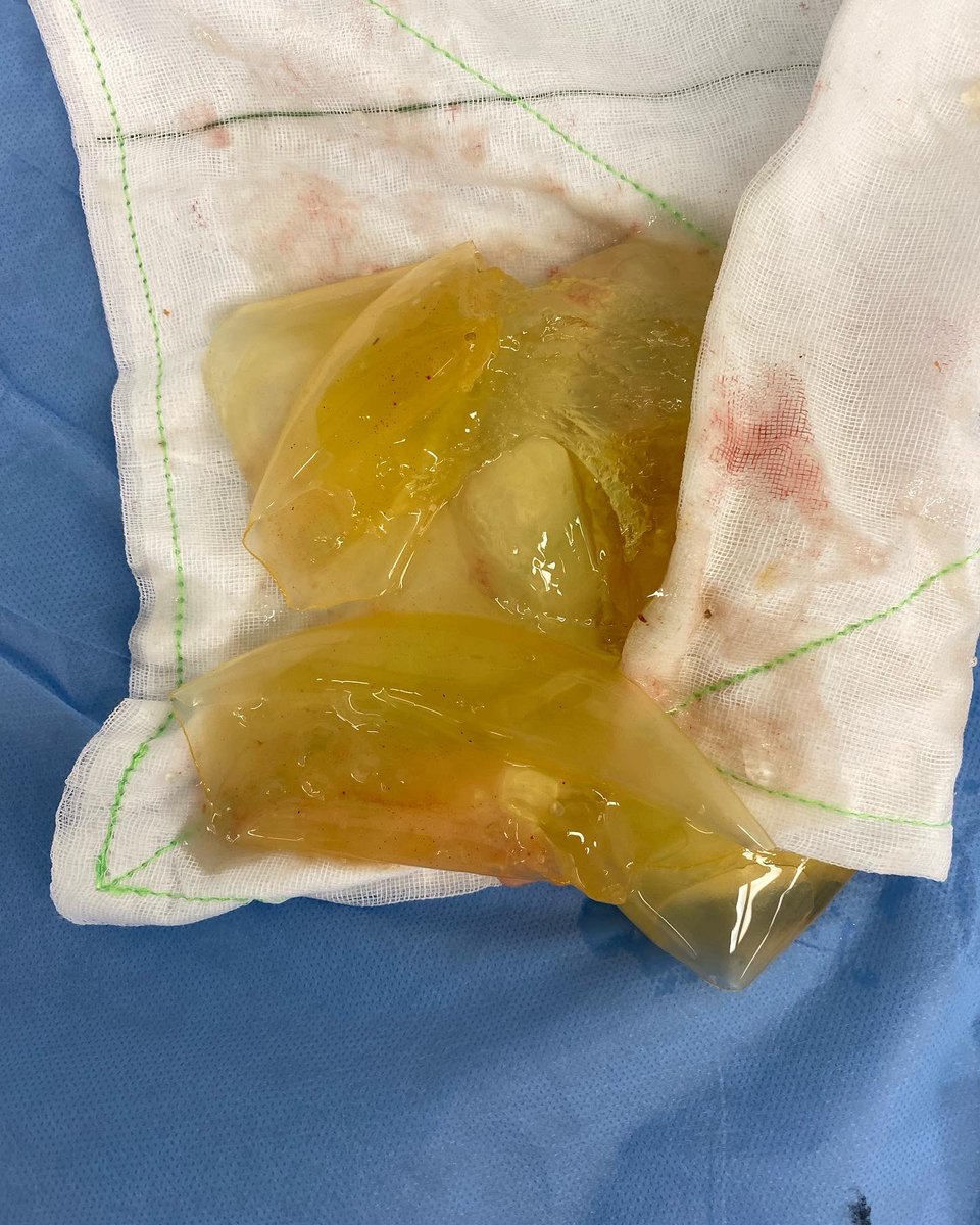 saferimplants's tweet photo. This patient presented with a ruptured implant inserted overseas. The intact implant on the other side had no markings on it at all - she was assured at the time that they were using US manufactured devices. Anyone know who makes these? #Beinformed #Getchecked #Staylocal https://t.co/gZyF3Gawsi
