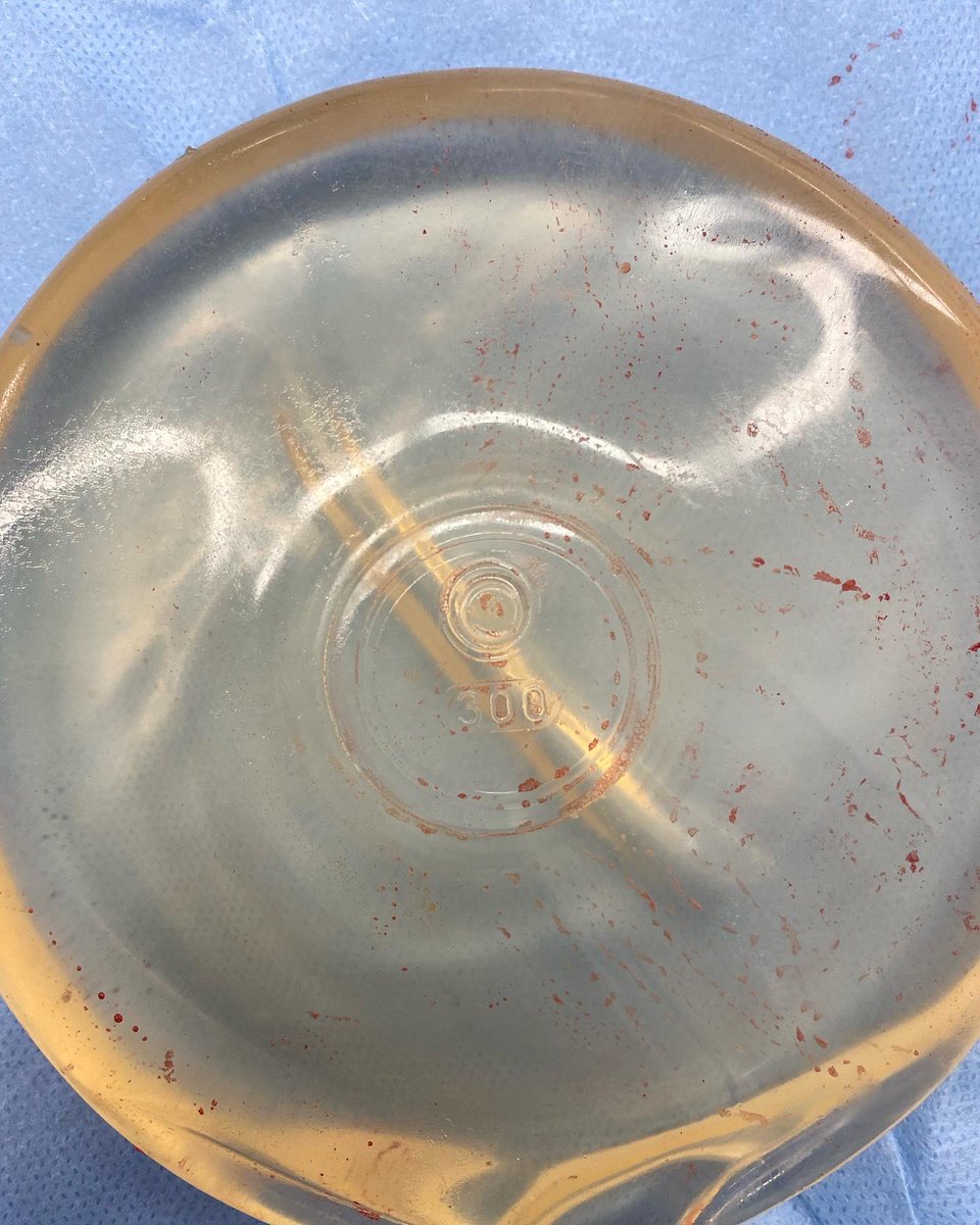 saferimplants's tweet photo. This patient presented with a ruptured implant inserted overseas. The intact implant on the other side had no markings on it at all - she was assured at the time that they were using US manufactured devices. Anyone know who makes these? #Beinformed #Getchecked #Staylocal https://t.co/gZyF3Gawsi