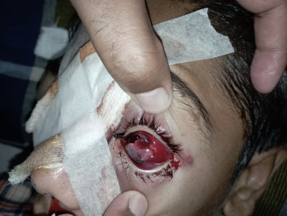 ShallumVohr's tweet photo. Today i attended a call from #ENT department, this young boy lost his both eyes in #RTA, wear helmet during #motorcycle ride! https://t.co/jvqUuQLcVg