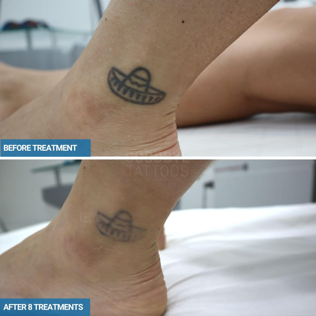 GoodbyeTattoos on X: "Great progress after 8 treatments. A few things about this tattoo you should know. Its only 1 year old and its on the ankle. As we've said before the