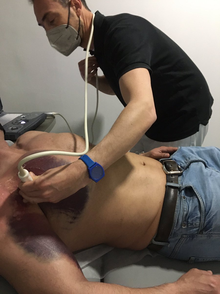 clinicaalicante's tweet photo. Culturista profesional,rotura tendón del pectoral mayor, ➡️derivado a cirugía e intervención inmediata. No control de cargas ➕fatiga muscular #deportedeelite #fisioterapiaalicante #fisioterapiadeportiva #clinicaalicante https://t.co/3b05FUSr4n