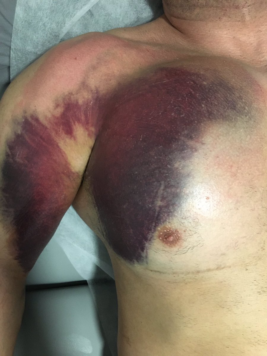 clinicaalicante's tweet photo. Culturista profesional,rotura tendón del pectoral mayor, ➡️derivado a cirugía e intervención inmediata. No control de cargas ➕fatiga muscular #deportedeelite #fisioterapiaalicante #fisioterapiadeportiva #clinicaalicante https://t.co/3b05FUSr4n