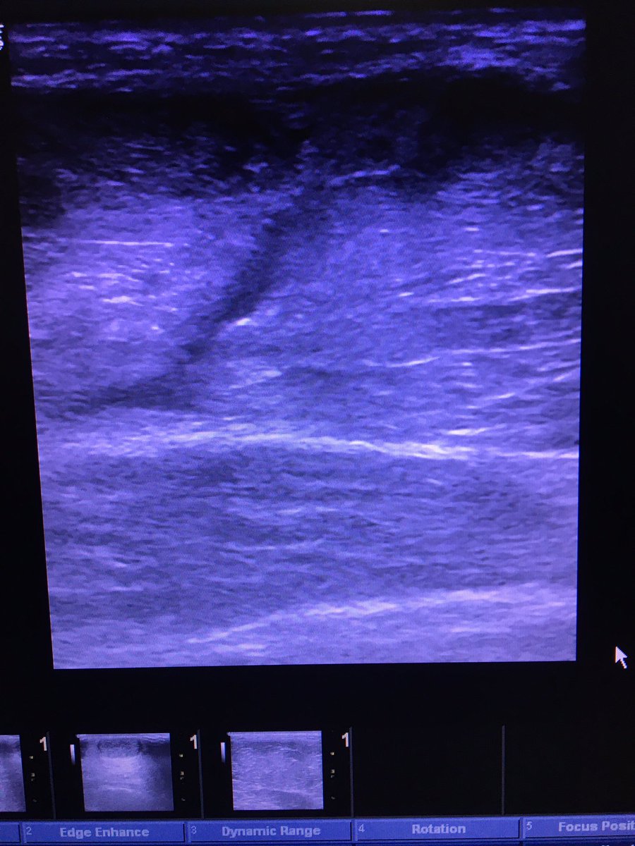 clinicaalicante's tweet photo. Culturista profesional,rotura tendón del pectoral mayor, ➡️derivado a cirugía e intervención inmediata. No control de cargas ➕fatiga muscular #deportedeelite #fisioterapiaalicante #fisioterapiadeportiva #clinicaalicante https://t.co/3b05FUSr4n