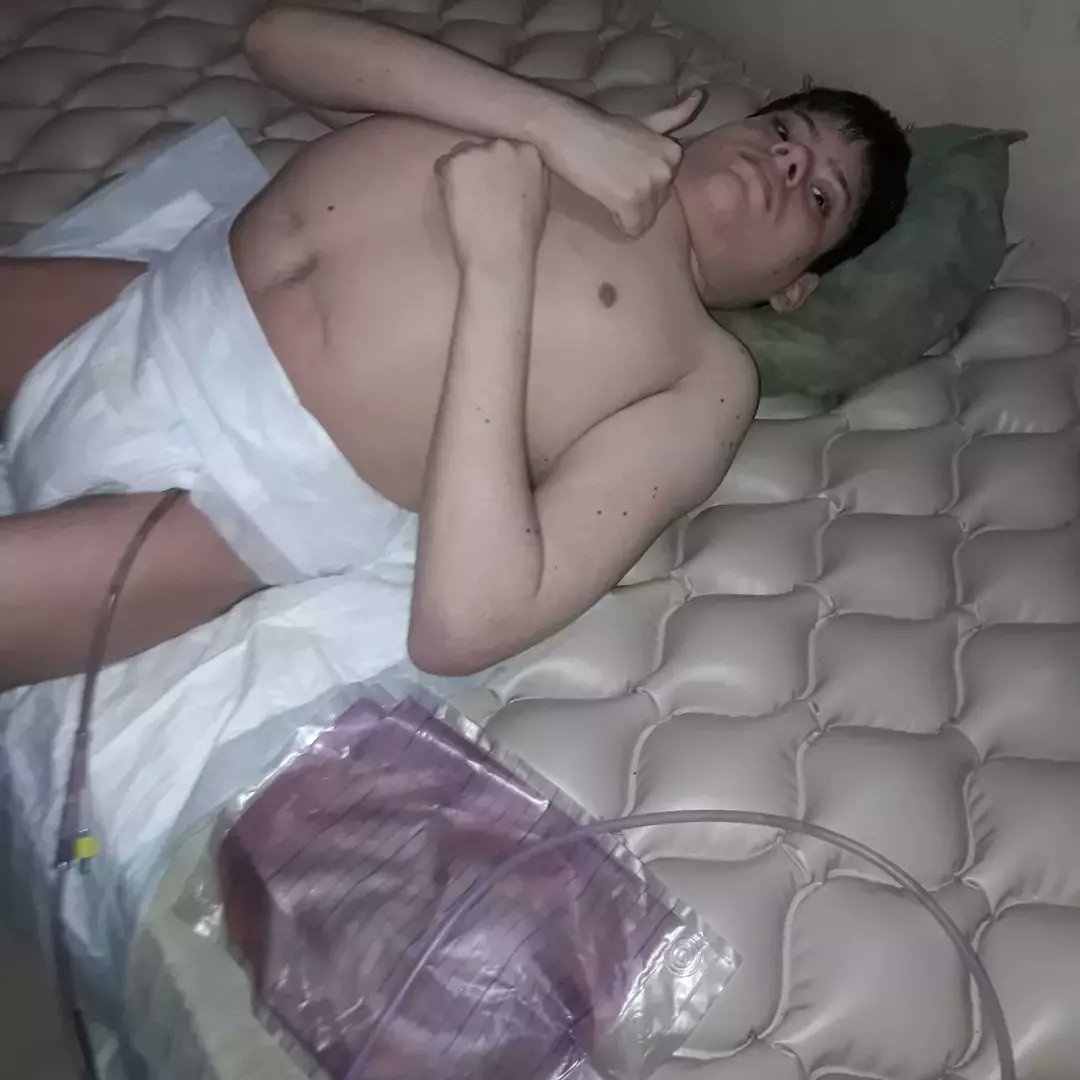 manuel02101's tweet photo. NO PUEDO CAMINAR NI VOY A CAMINAR NUNCA,17 AÑOS EN CAMA,13 INTERVENCIONES QUIRÚRGICAS, LAMENTABLEMENTE NO TENEMOS RECURSOS, HOY NOS TOCA PEDIR, MI CASO ES DE POR VIDA @NicolasMaduro @dcabellor @jaarreaza @Nahumjfernandez @gestionperfecta @JacquelinePSUV @Grecia_Jpsuv https://t.co/a461wznX3e
