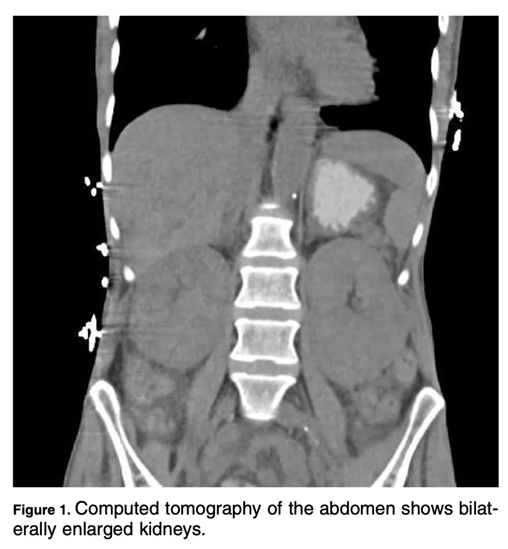 Bilateral Flank Pain