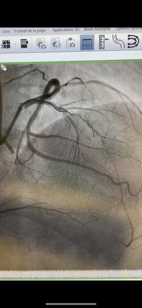 AntoineVaillier's tweet photo. Nice CTO case in La Timone hospital, Marseille. LAD CTO. Retrograde access. Resistant calcified lesion. Wire exchange with double lumen catheter . Rotablator . Good result confirmed by OCT. @deharo_pierre @CuissetDr @Ferrarajerome1 @aphm_actu @nicolasamabile @MLCTOcourse https://t.co/CXWXIv50JF
