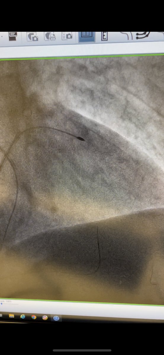 AntoineVaillier's tweet photo. Nice CTO case in La Timone hospital, Marseille. LAD CTO. Retrograde access. Resistant calcified lesion. Wire exchange with double lumen catheter . Rotablator . Good result confirmed by OCT. @deharo_pierre @CuissetDr @Ferrarajerome1 @aphm_actu @nicolasamabile @MLCTOcourse https://t.co/CXWXIv50JF