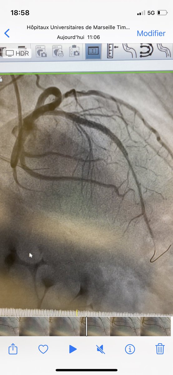 AntoineVaillier's tweet photo. Nice CTO case in La Timone hospital, Marseille. LAD CTO. Retrograde access. Resistant calcified lesion. Wire exchange with double lumen catheter . Rotablator . Good result confirmed by OCT. @deharo_pierre @CuissetDr @Ferrarajerome1 @aphm_actu @nicolasamabile @MLCTOcourse https://t.co/CXWXIv50JF