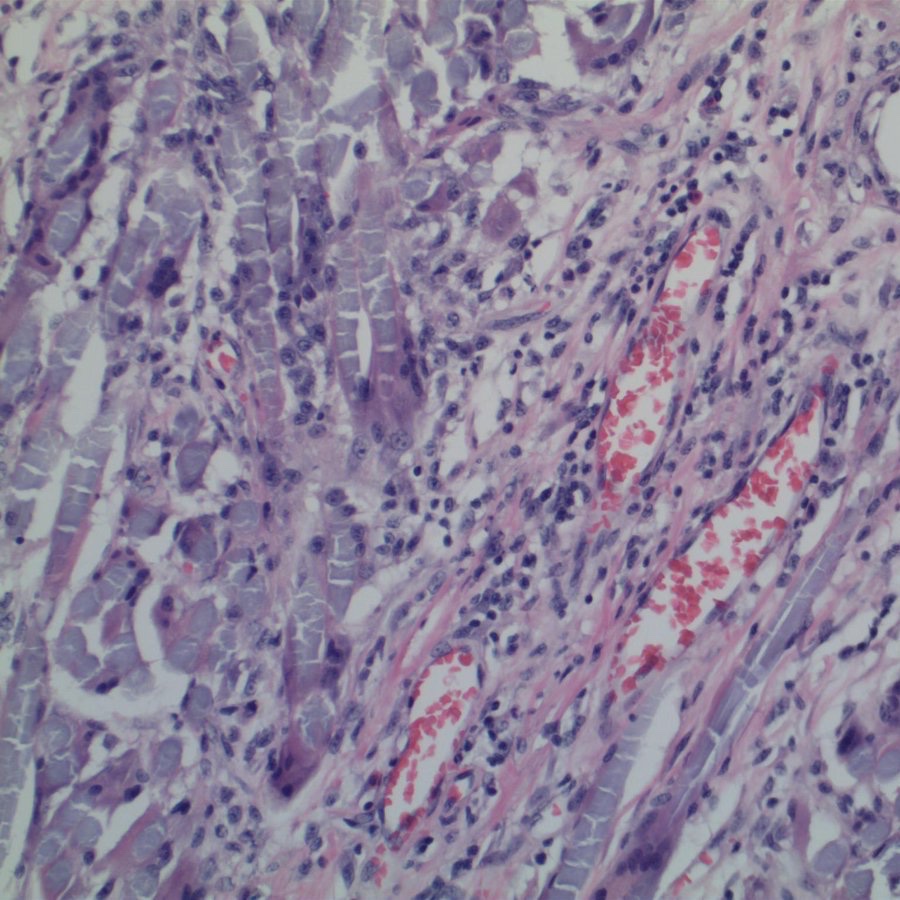 EKoubaMD's tweet photo. Suture granuloma. PET avid serosal abnormality h/o rectal carcinoma. Frozen section. https://t.co/d1sq01i1Ni
#pathology #frozenpath #PathTwitter https://t.co/3tVNeMDLBK