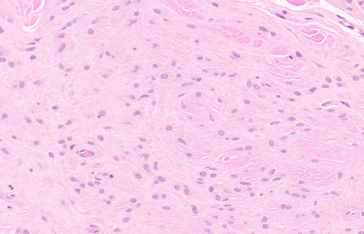 MYOEPITHELIOMA-LIKE HYALINIZING EPITHELIOID TUMOUR. NGS: OGT::FOXO4. NB: very rare; lobulated;  polygonal-spindle cells; pale eosinophilic cytoplasm; monomorphic round-ovoid nuclei; abundant hyalinized stroma. PMID: 31567281, 33455033