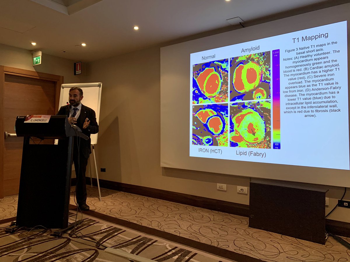 GiuseppeGalati_'s tweet photo. ๐ฅ Prof @glimongelli at The #1st #NationalCongress of the #ItalianHoT (Day2) ๐ฎ๐น
Giving a lecture on โ#Cardiomyopathies: Focus on #Fabry & #Amyloid: State of the artโ @JavedButler1 @JJheart_doc
@DrMarthaGulati @gbiondizoccai @nephondemand @DLBHATTMD @SilCastelletti @IndolfiCiro https://t.co/p0qfuznXsH