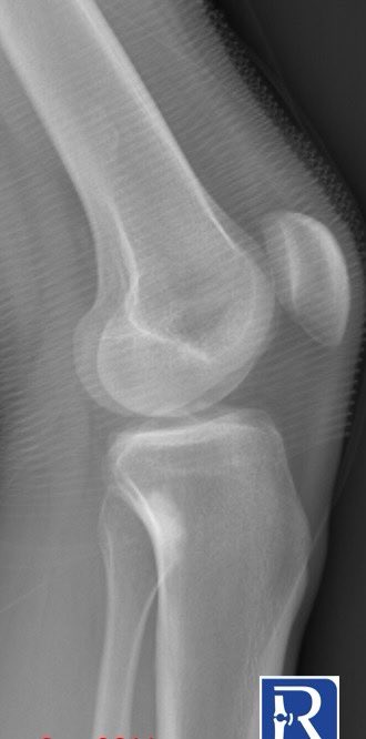 24 years old male with right knee pain and antalgic gait. Lateral knee X-ray shows sclerotic bone lesion in proximal metaphysis of tibia. #radiology #mskrad #radres #MedTwitter