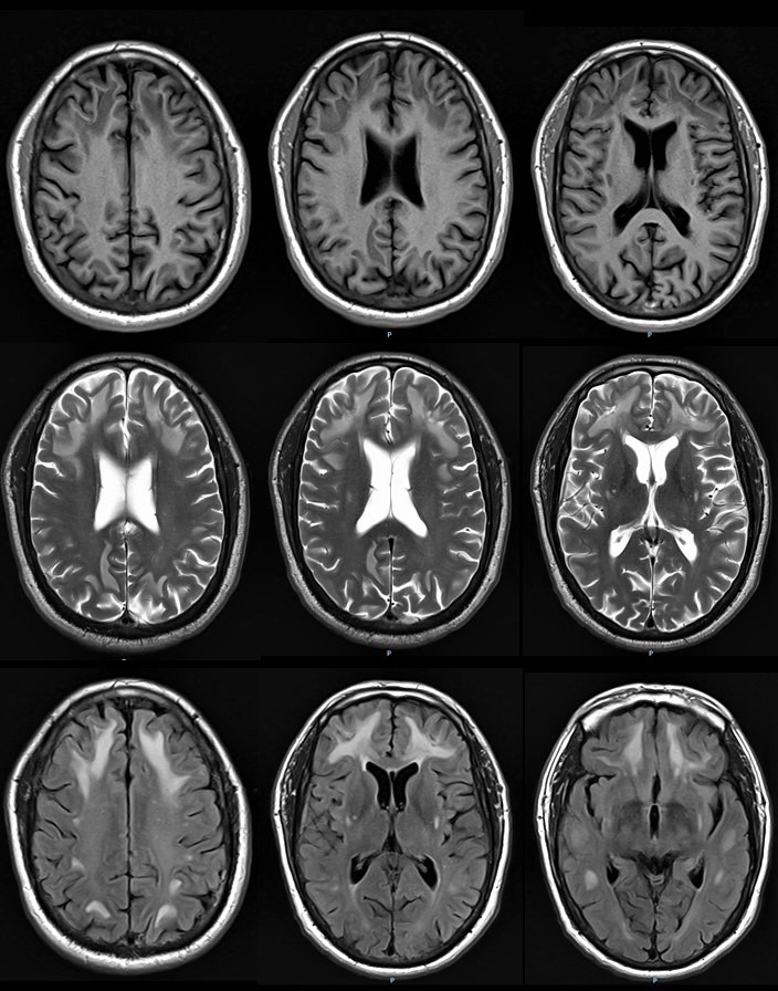 JRBneuropsiq's tweet photo. A middle-aged man had a 6-month disorder: temporal disorientation, severe working memory dysfunction, semantic and episodic memory retrieval deficits, metacognitive deficits (anosognosia), and atypical delusions (reduplicative paramnesia). What do you see in these images? https://t.co/BCBGECg6ry