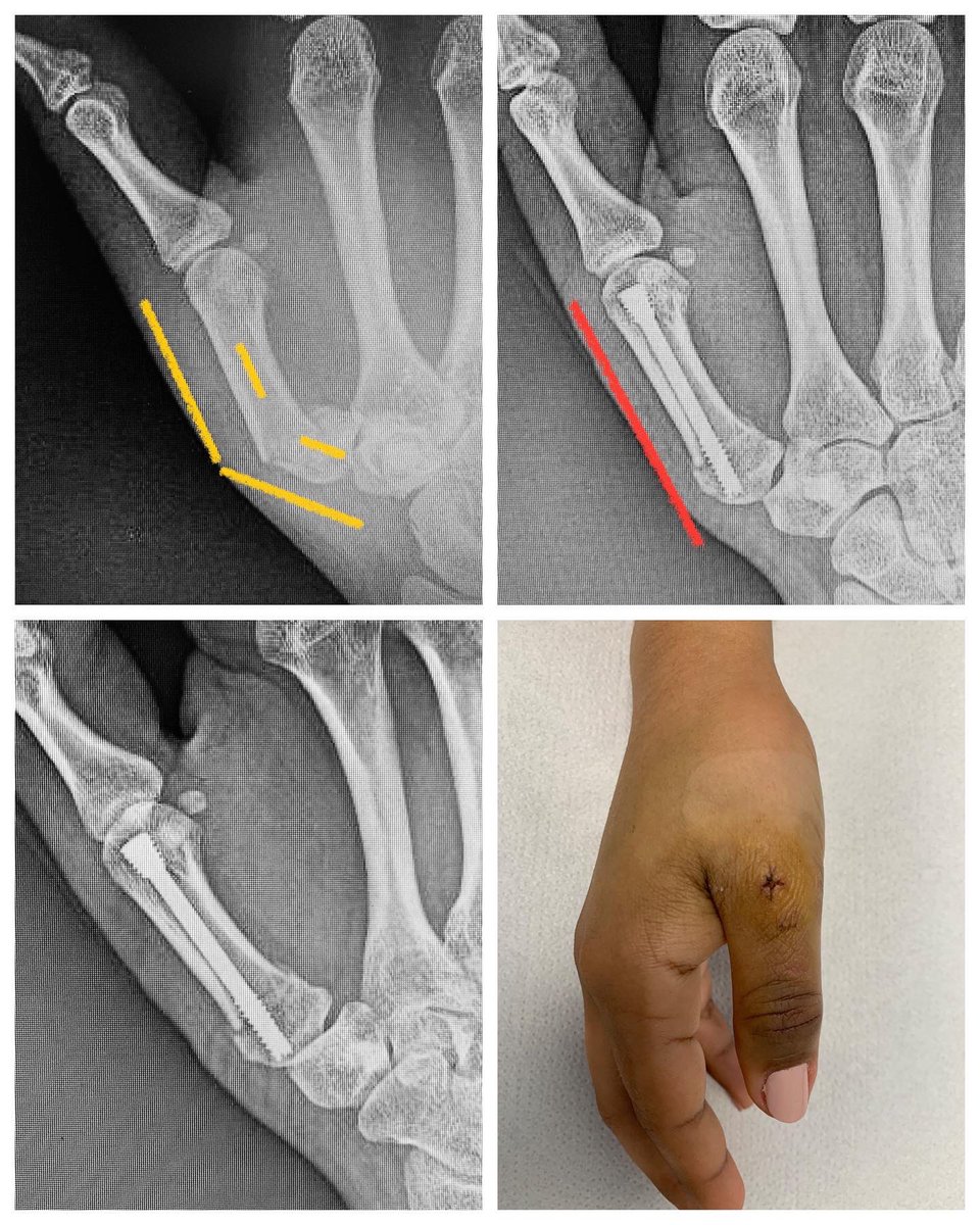 La mayoría de cirujanos hubieran tratado esta fractura mediante AK o placa y tornillos (según la encuesta realizada)
▪️Los tornillos endomedulares aúnan las ventajas de ambos métodos anteriores 
▪️Sigo hilo