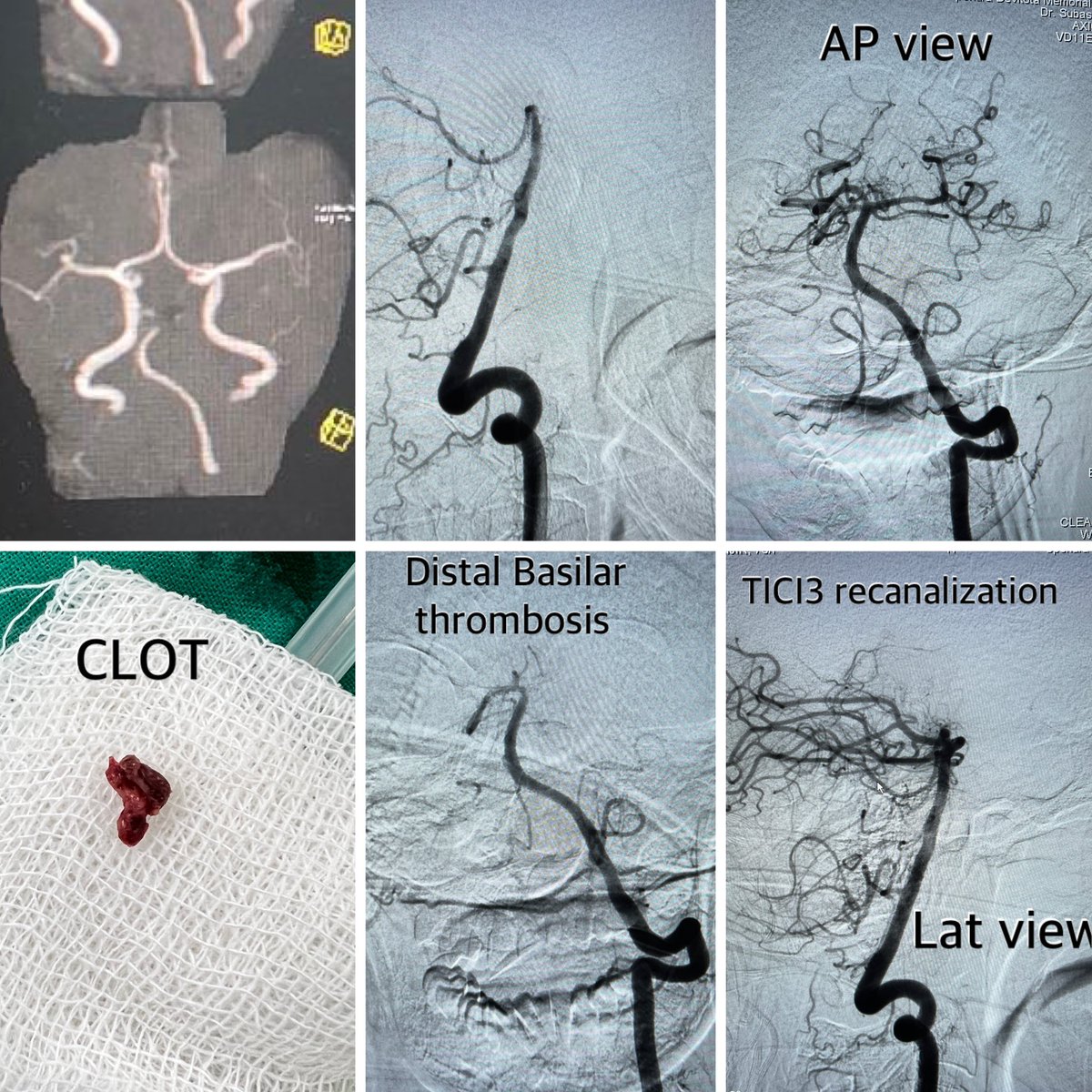 dr_phuyal's tweet photo. Neurointervention Nepal: 
70yF with acute right sided paralysis and slurring 5h duration. Posterior circulation LVO seen on imaging.
Performed emergency minimally invasive operation (MT) to save her life
#teamwork 
#neurointervention #strokeawareness @MT2020 @PenNeuro @SNISinfo https://t.co/adWUMKUmLV