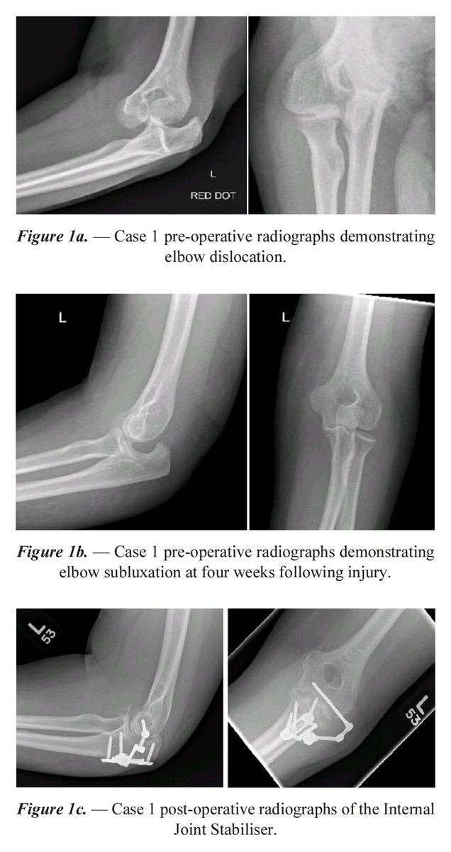 SpOrthopod's tweet image. The use of the internal joint stabiliser for elbow instability Report of two cases and systematic review actaorthopaedica.be/archive/volume… 

#orthotwitter #elbows #Trauma