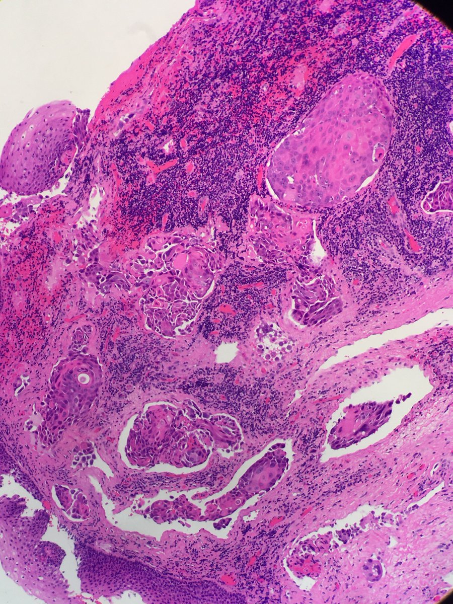 megothelioma's tweet photo. Crazy-looking SCC in a lymphoid tissue specimen. Staining with D240 and CD31 highlighted extensive lymphovascular invasion #pathtwitter #MSGPath https://t.co/9H0MnlFk0M