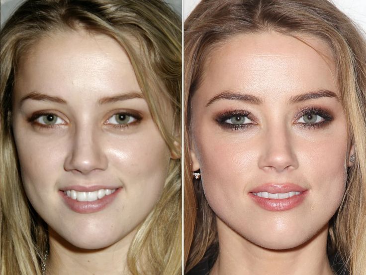 Since I've address Amber Heard's documented issue of picking at her lips, I wanted to also address that infection from lip-fillers/lip-injections is 100% possible. Her lips noticeably enhanced during the relationship. https://www.allure.com/story/infected-lip-fillers-popping-video