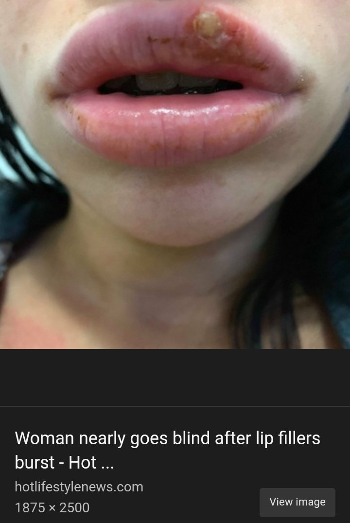 Since I've address Amber Heard's documented issue of picking at her lips, I wanted to also address that infection from lip-fillers/lip-injections is 100% possible. Her lips noticeably enhanced during the relationship. https://www.allure.com/story/infected-lip-fillers-popping-video