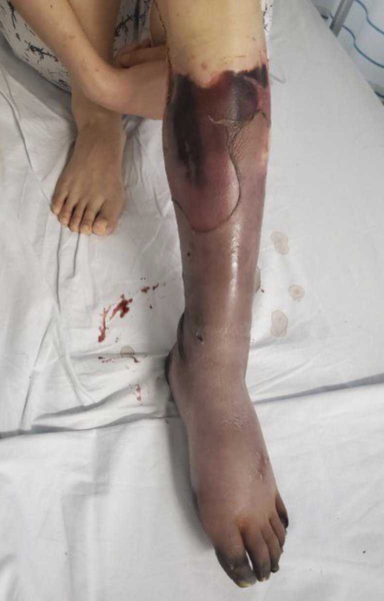 EmmaLouMarsha11's tweet photo. Horrific. 30yr old woman necrosis pic. before her left leg amputation. blood clots formed in her left leg..she was diagnosed with myocardial due to the blood clot, her left leg amputated currently below her knee. Source

@Covid19vaccinevictims https://t.co/hZFkMCRjv3