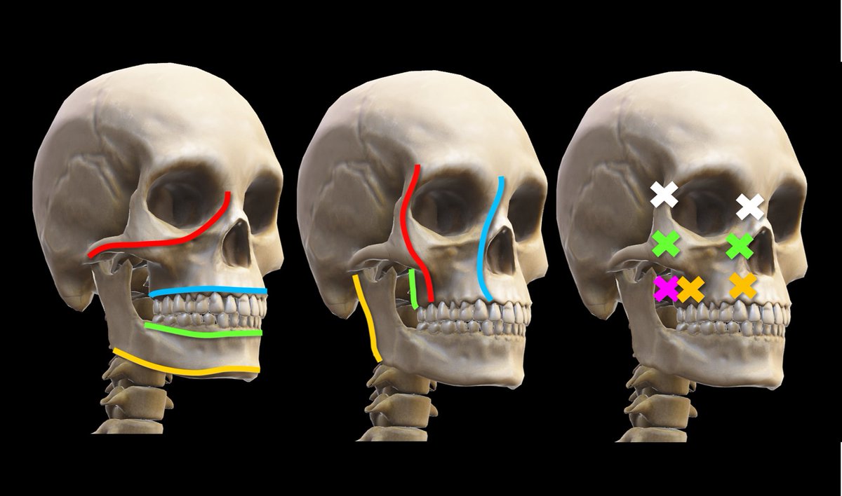 1/ My fellows complained they hate memorizing classifications, like LeFort. I thought, “There must be a better way—maybe understanding instead of memorizing.” A #tweetorial about understanding the LeFort classification. #FOAMed #medtwitter #Medstudenttwitter @medtweetorials